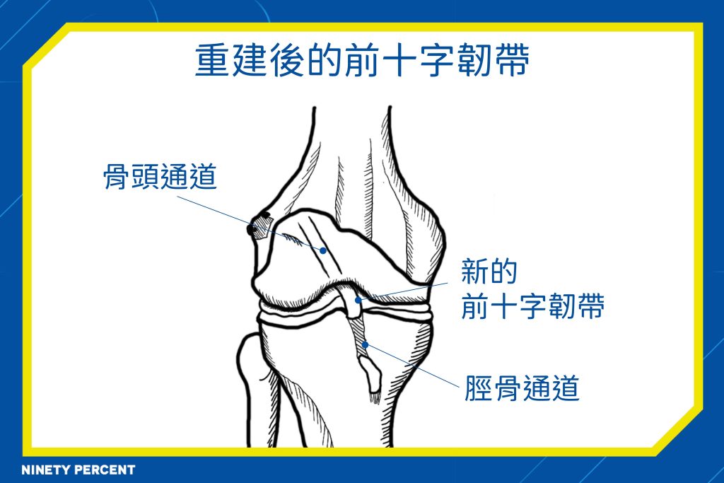 十字韌帶重建-十字韌帶手術*十字韌帶