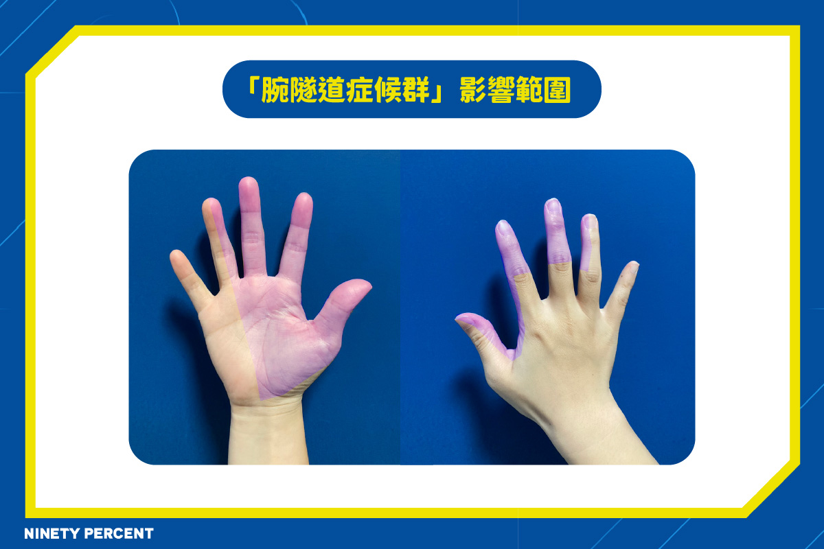 腕隧道症候群-手麻-用滑鼠手麻