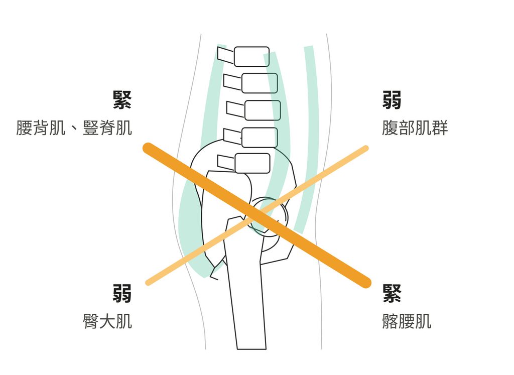 下交叉症候群示意圖
