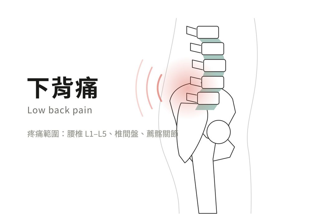 骨盆前傾容易造成腰痠背痛